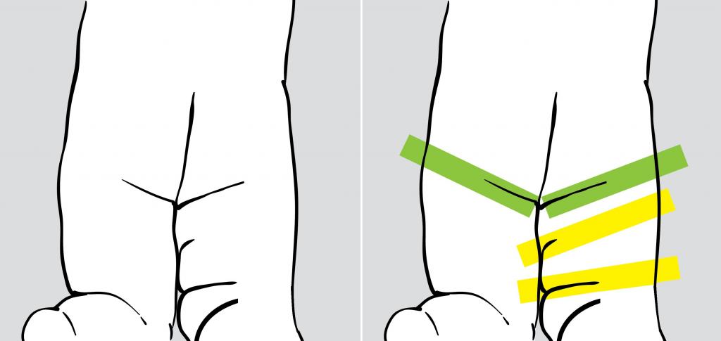 Гимнастика массаж при дисплазии тазобедренного сустава thumbnail