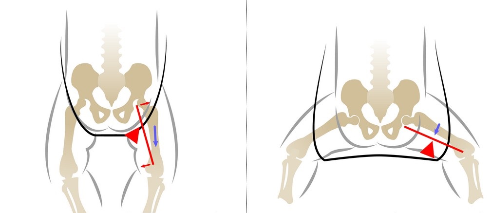 Дисплазия тазобедренных суставов массаж гимнастика thumbnail