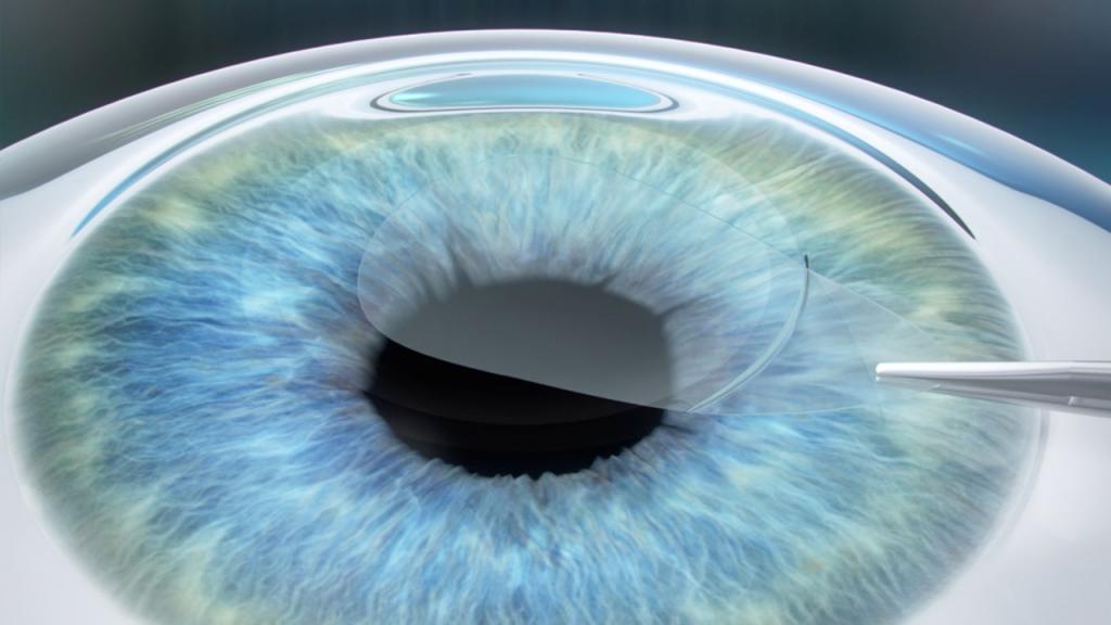 Лазерное лечение глаз видео thumbnail