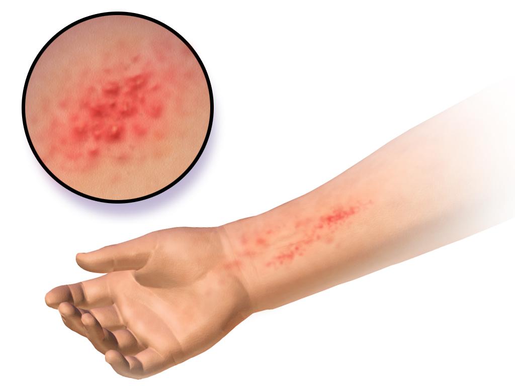 Что такое искусственный дерматит thumbnail