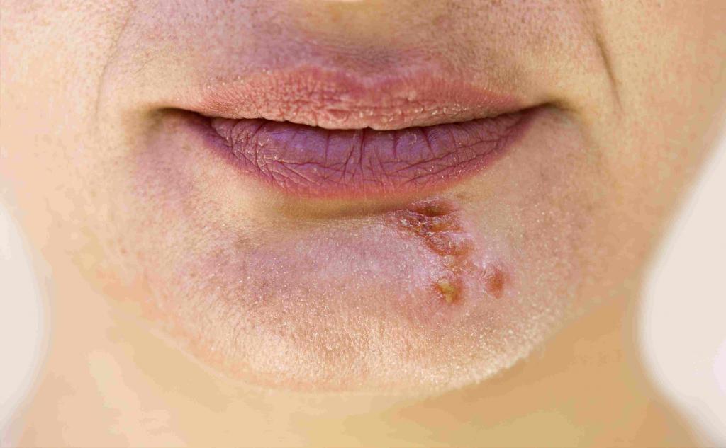 Сыпь в области губ и подбородка thumbnail