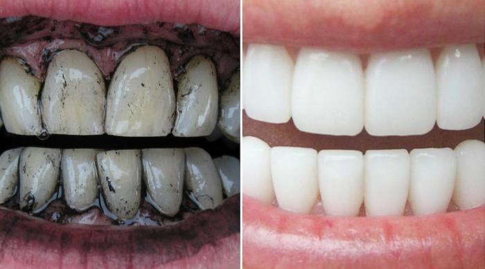 активирован уголь для отбеливания зубов