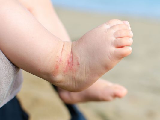 дерматит у детей на ногах