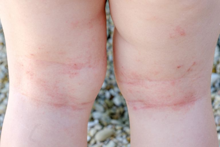 дерматит на ногах у ребенка фото