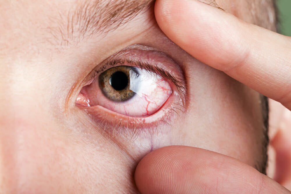 Клещи на глазах у ребенка лечение thumbnail
