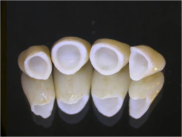 Противопоказания протезирования зубов коронками thumbnail