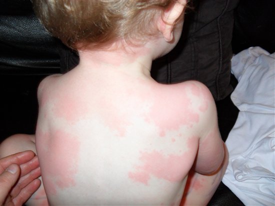 острая аллергическая крапивница у ребенка