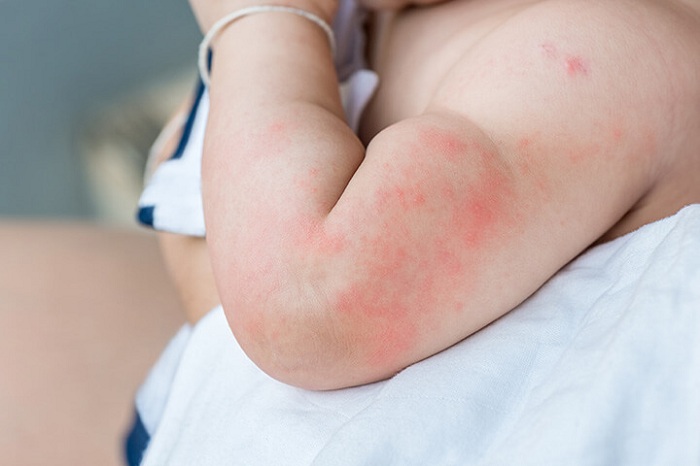 аллергическая крапивница у детей симптомы профилактика