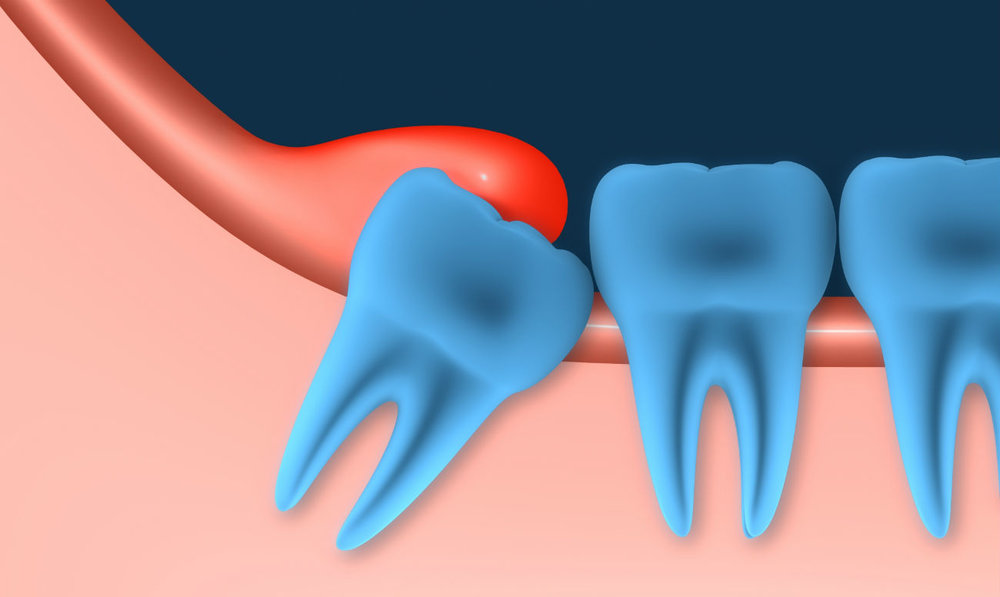 Воспаление капюшона над зубом мудрости лечение thumbnail