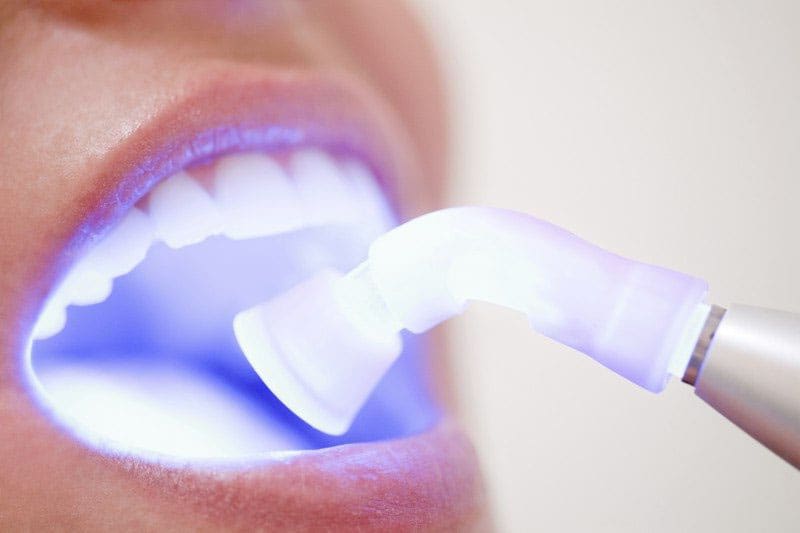 Лазерный прибор для лечения зубов thumbnail