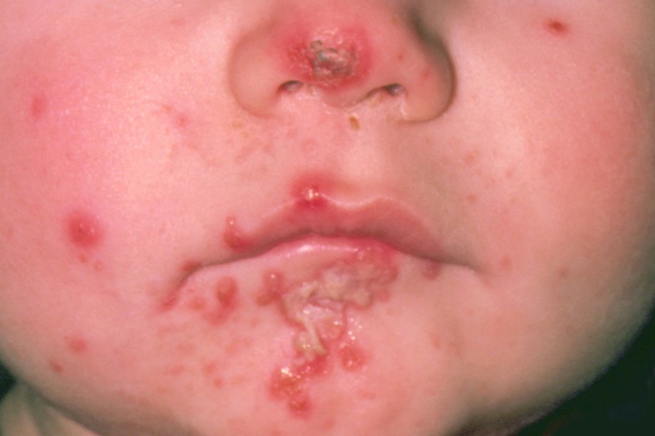 Аллергия на бороде у ребенка фото с пояснениями thumbnail