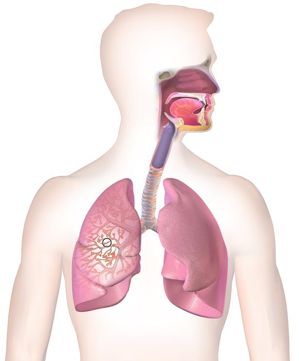 можно ли вылечить начальную стадию бронхиальную астму