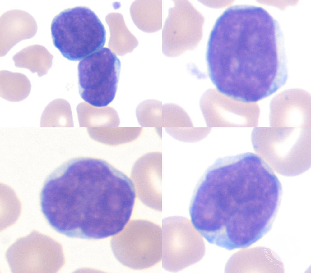 Анализ на cd4 лимфоциты в крови thumbnail