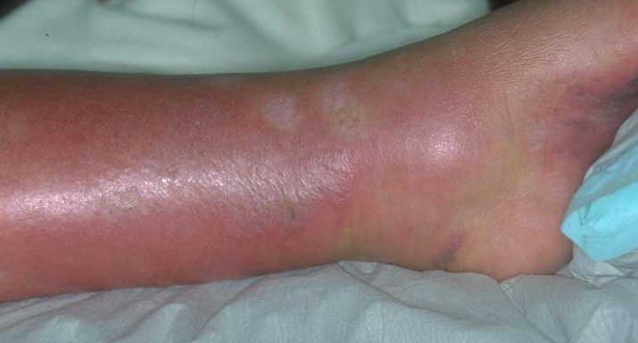 Лечение рожистого воспаления ноги мелом thumbnail