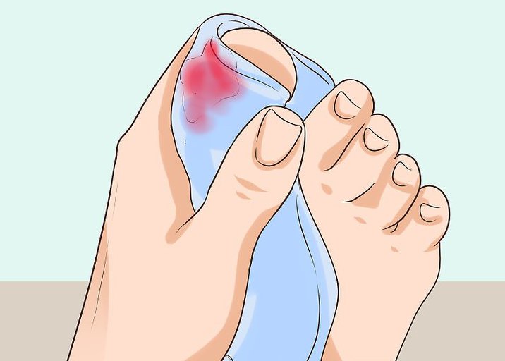Как вылечить палец на ноге без ногтя thumbnail