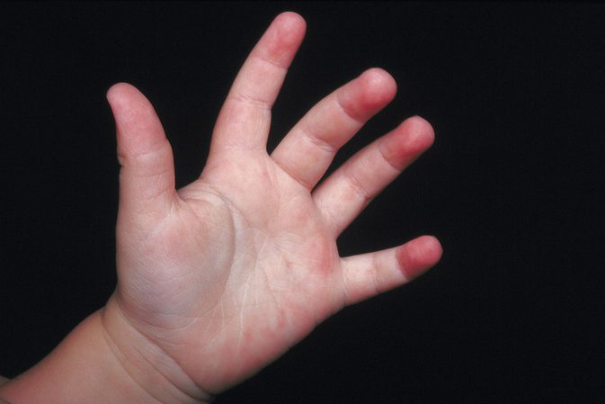 Ребенок 2 года трясет рукой thumbnail