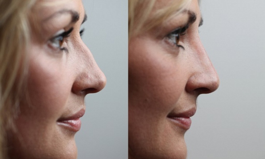 Костная мозоль после перелома носа фото до и после thumbnail