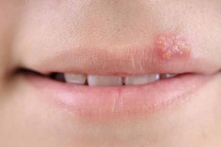 Корвалол для лечения герпеса на губах отзывы