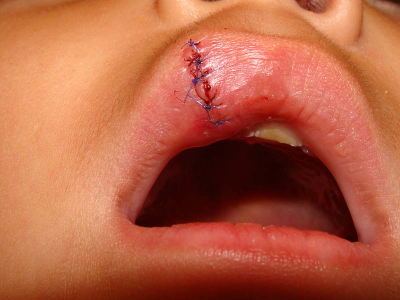 Рассечение губы лечение в домашних условиях thumbnail