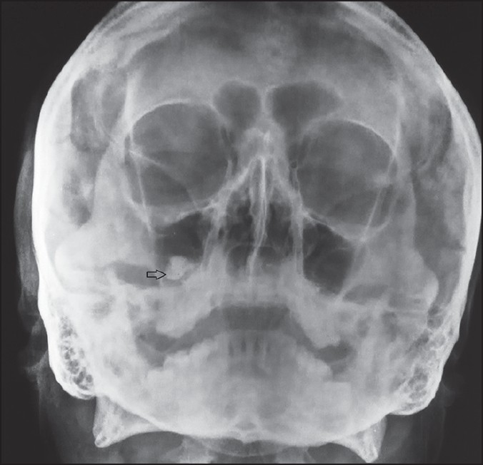 затемнение гайморовой пазухи на рентгене