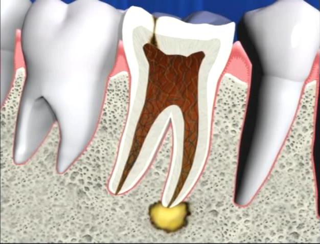 Гной в корне зуба как называется болезнь thumbnail