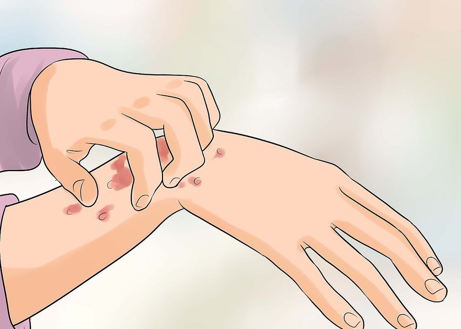 Как лечить сыпь на кистях thumbnail
