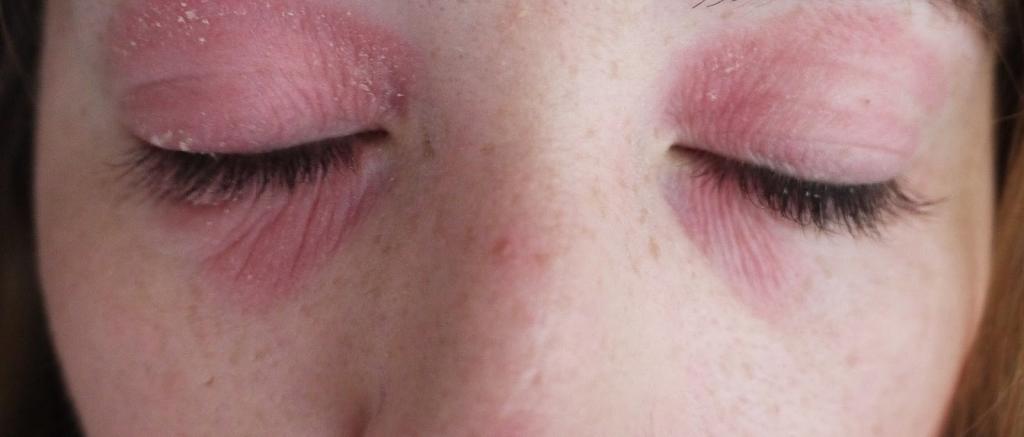Раздражение кожи вокруг глаз чем лечить thumbnail