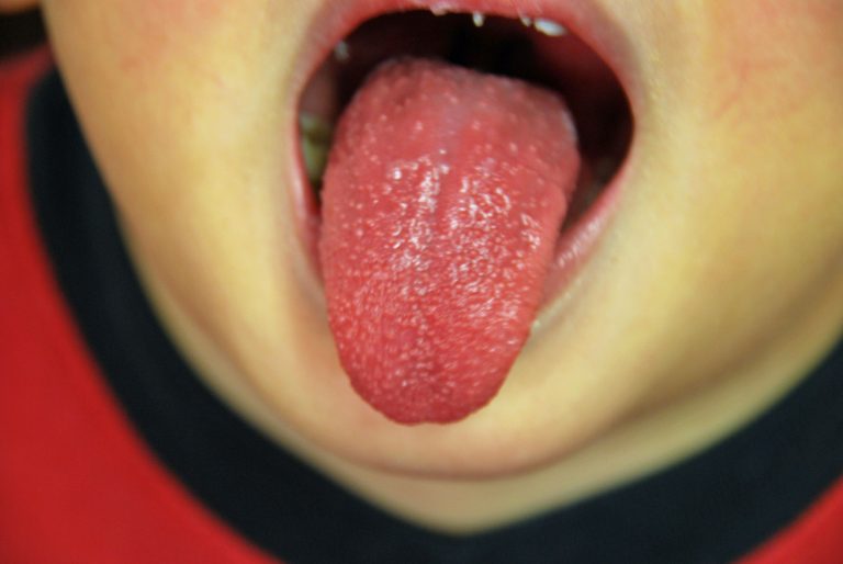 Высокая температура у ребенка болит язык thumbnail