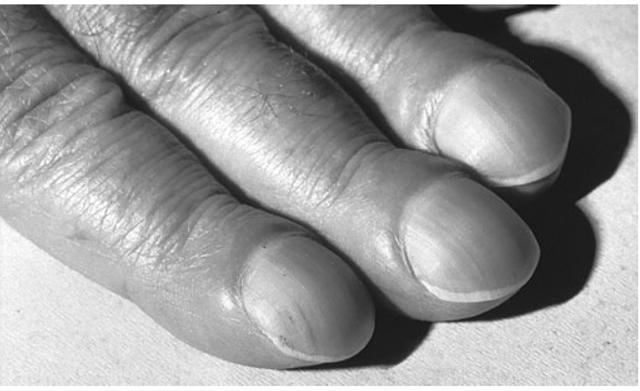 Деформация пальцев при болезнях легких