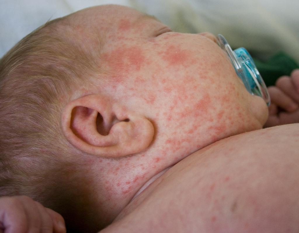 Что такое эспумизан для новорожденных аллергия thumbnail