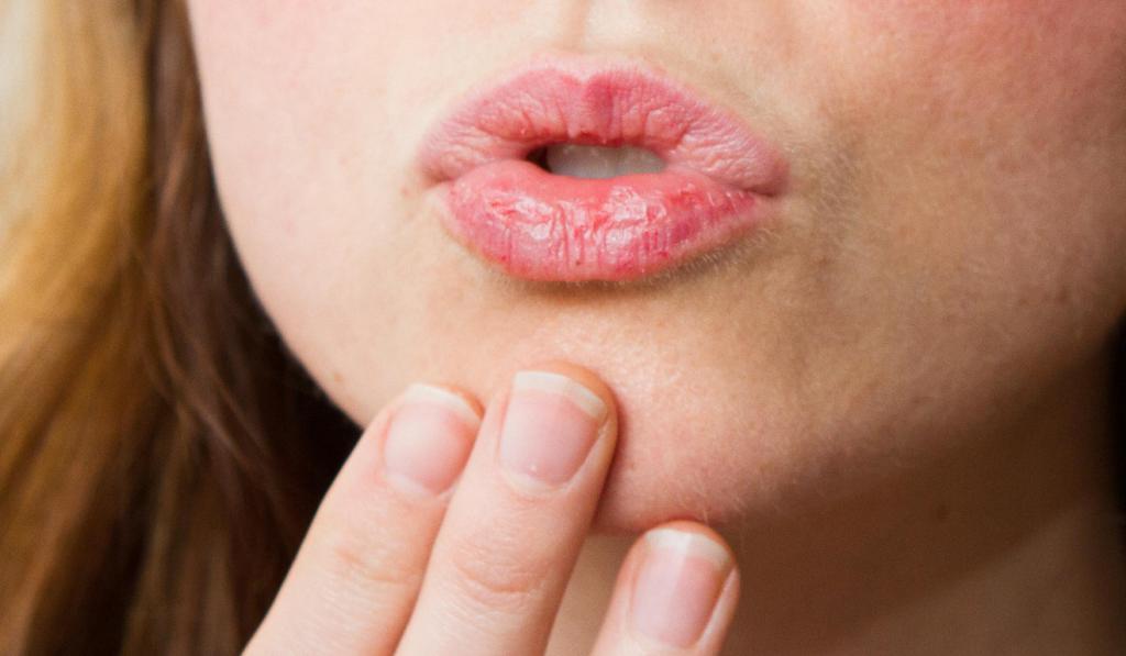 Как лечить молочницу на губах у взрослого thumbnail