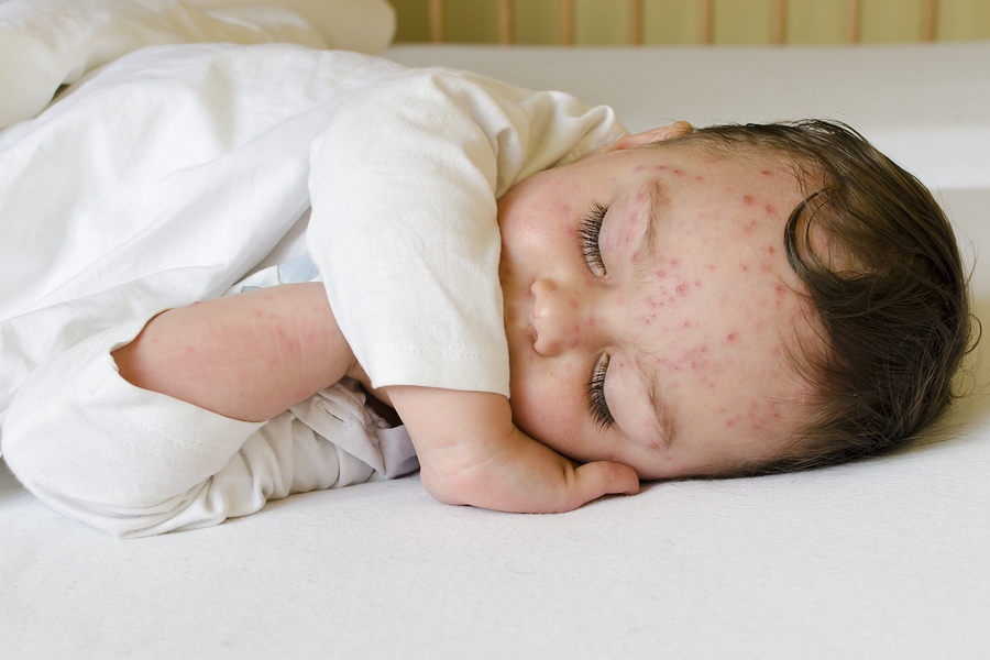 преднизолон детям при аллергии