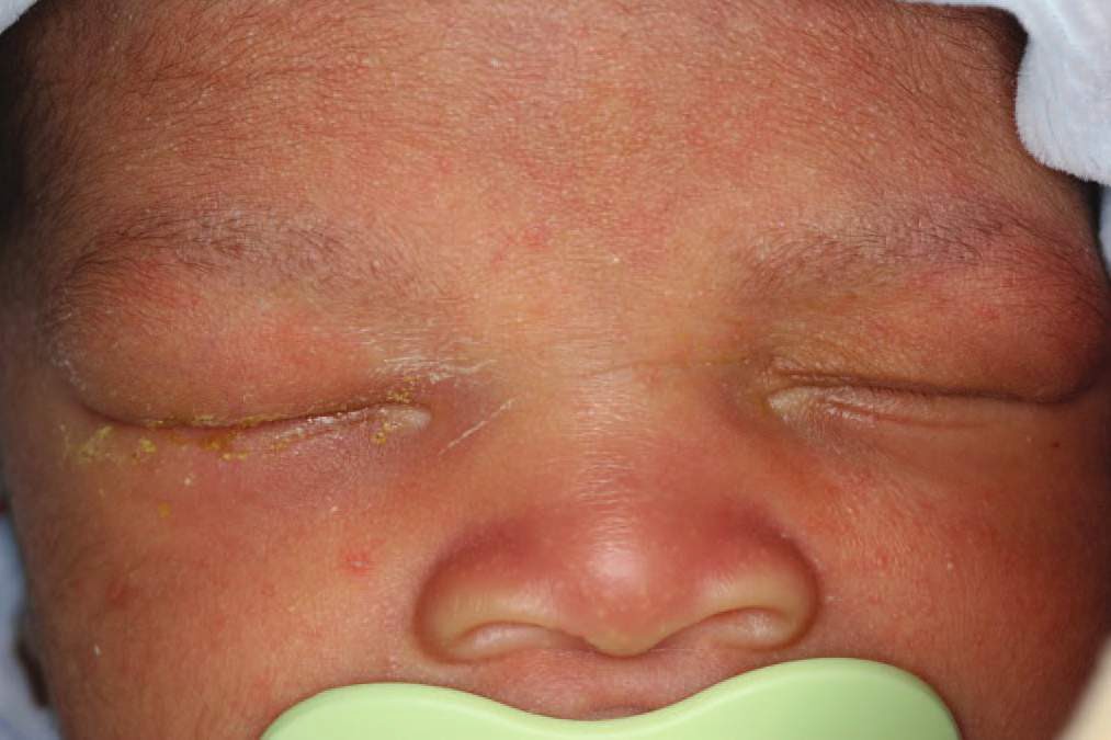 Раздражение вокруг глаз у новорожденных thumbnail