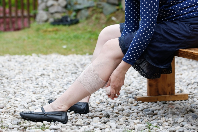 Облитерирующий атеросклероз сосудов ног фото thumbnail