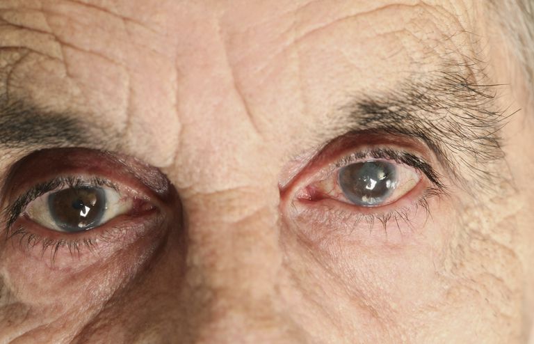 глазные капли при глаукоме и катаракте список