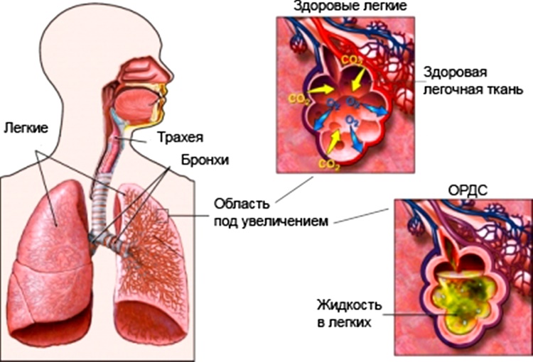 Характер дыхания пациента при альвеолярном отеке легких thumbnail