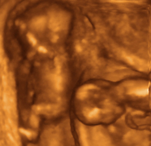 Снимок многоплодной беременности