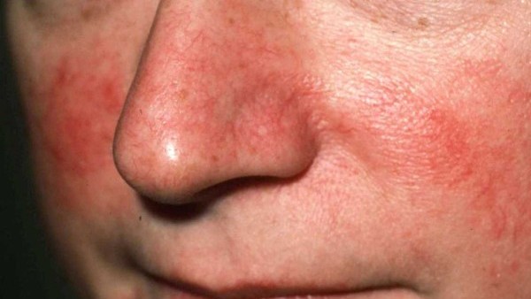 Аллергия на носу красное пятно thumbnail