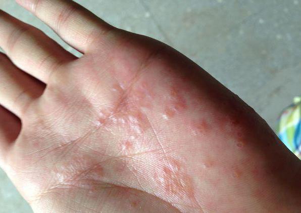 Заболевания пальцев рук кожи thumbnail