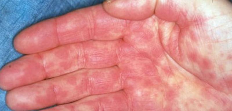 Заболевания кожи в области рук thumbnail