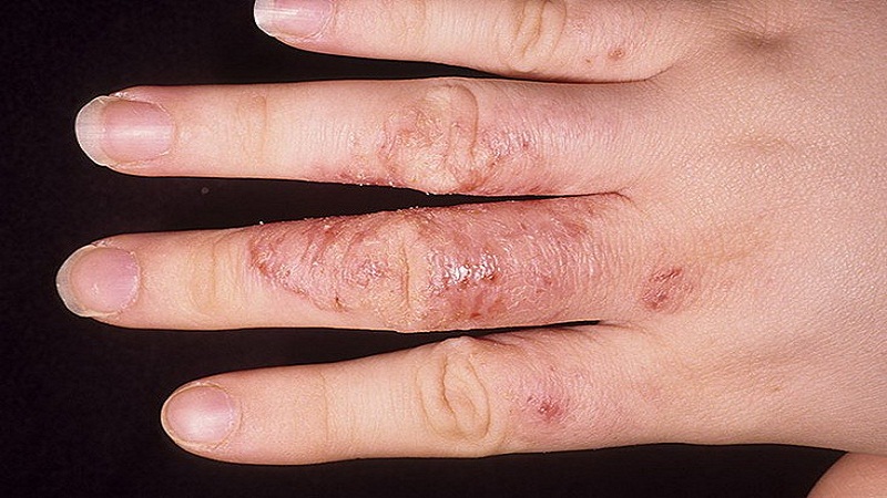 Болячки на коже пальцев рук thumbnail