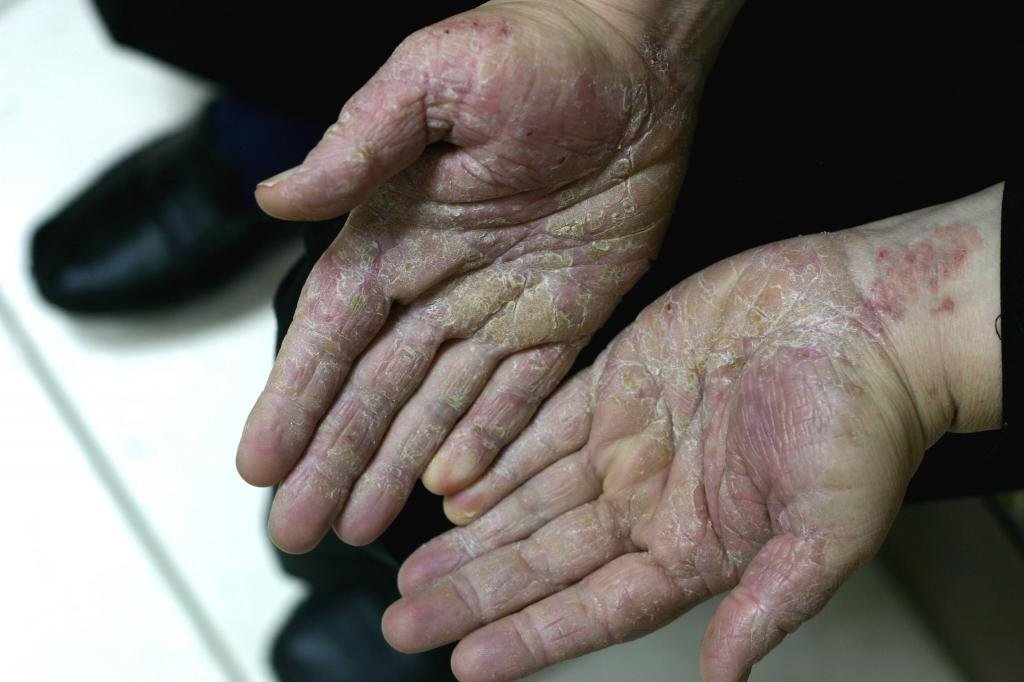 Заболевания кожи рук заразные thumbnail