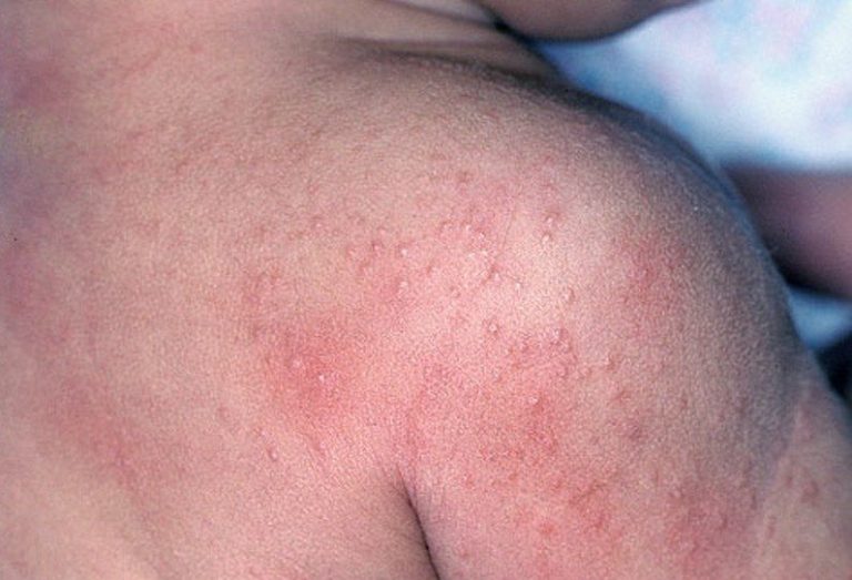 Что такое гепатит с в активной фазе thumbnail
