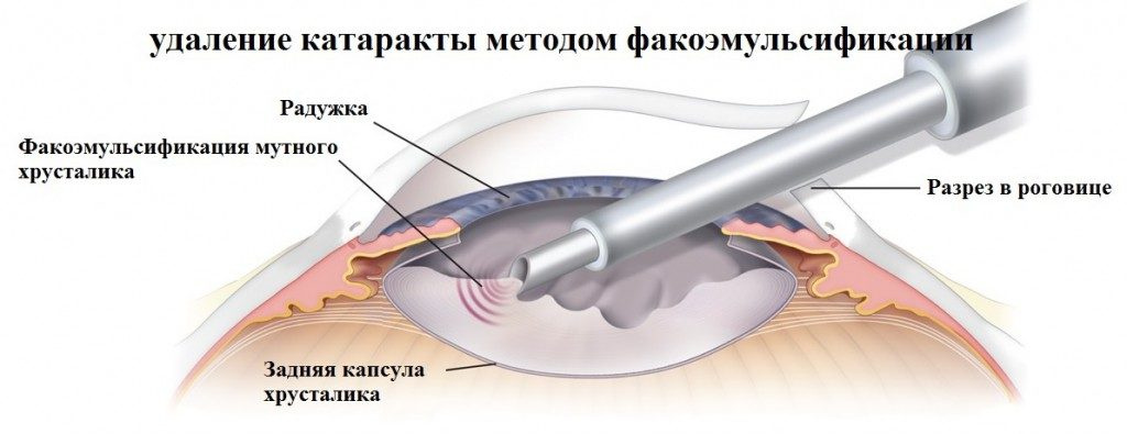 лечение глаукомы и катаракты