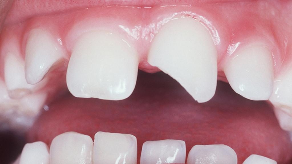 Перелом зуба лечение у детей thumbnail
