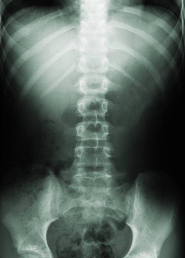синяки на позвоночнике рентген