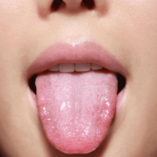 Опух язык какой врач лечит thumbnail