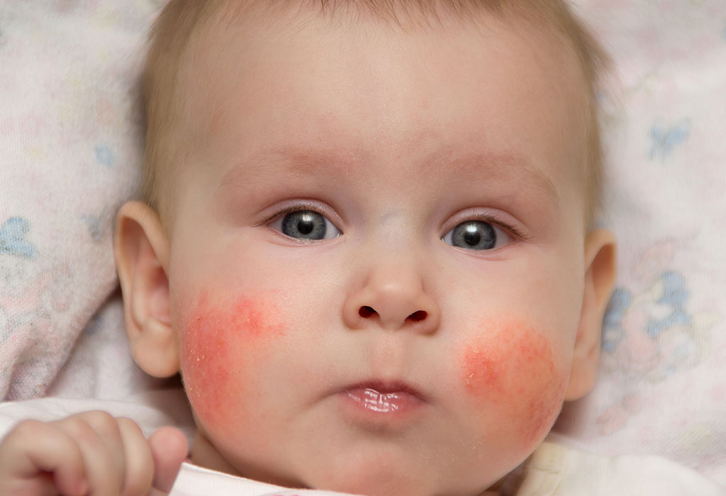 Чем протирать лицо новорожденного от аллергии thumbnail