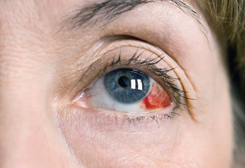 Кровоизлияние от ушиба глаза thumbnail