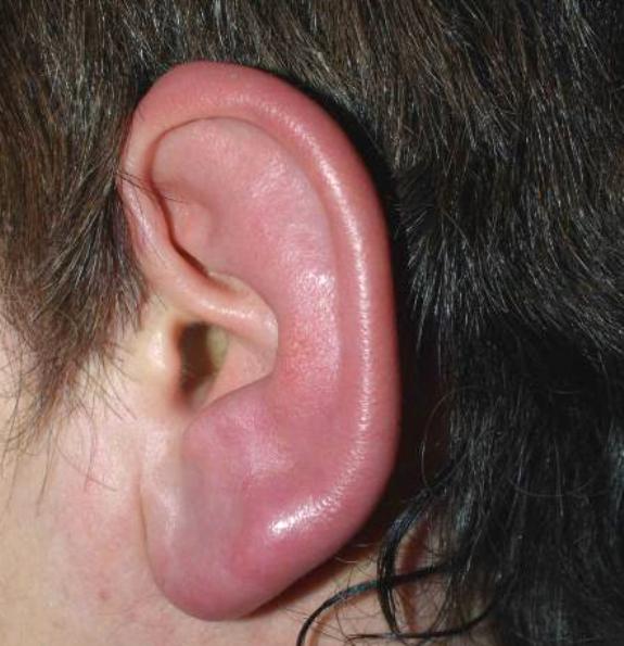 симптомы рожистого воспаления уха